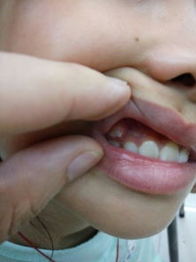 人的乳牙有多少颗？小朋友有多少颗牙齿