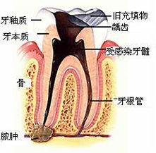 根管治疗术介绍 