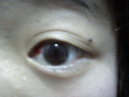 为什么我的左眼会好很多血 但是眼睛不痛也不痒.也看到东西也不模糊 