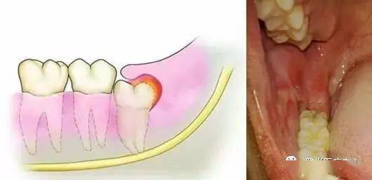 什么是智齿 对人体有什么危害 智齿是否都要拔除