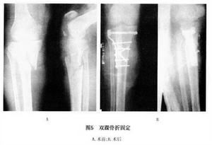 胫骨平台骨折训练图解 表情大全