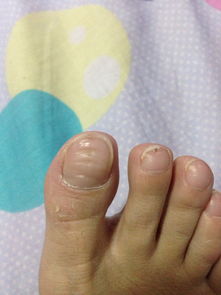 大脚趾指甲上长了几道深深的横纹,有一两年了,最近发现手指甲上也有了,求助,这是怎么回事 