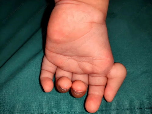 家里大人的拇指都是正常的,为什么宝宝的大拇指会看上去像悬浮着