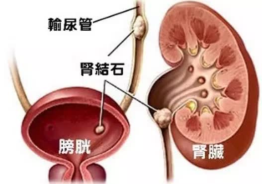 吃太好也会中招 泌尿系结石最爱招惹这些人