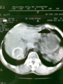 右肝钙化灶 斗图表情包大全 - 与 右肝钙化灶 相