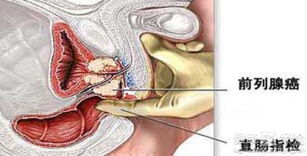 怎样提前发现前列腺癌