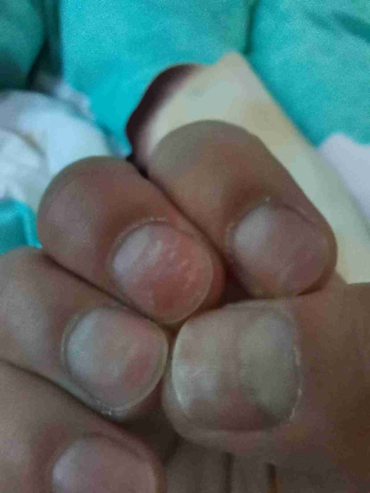 小孩手指上有白斑是什么原因