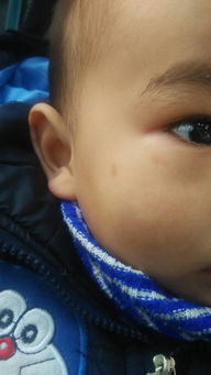 宝宝一岁多时候脸上长斑了 现在一岁四个月额头上有起了几块 去儿研 