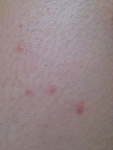 身上长了很多小红点,偶尔会痒,然后会变成一小一小块的,这是什么病,严重吗