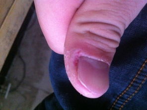右手大拇指指甲隔壁不知道长个什么东西,我剪了外面表皮,怀疑是鸡眼,怎么治疗