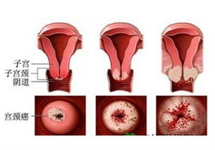 得了早中期宫颈癌还能治愈吗 