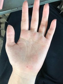 我左手手掌上长了一颗痣2017年长出来的代表什么02年出生 