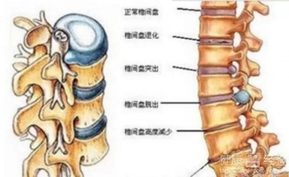 颈椎骨质增生压迫神经做这样的手术大概要多少钱