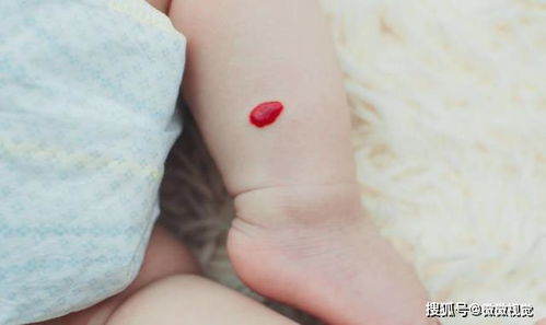 新生儿皮肤上的红痣,可能叫做 血管瘤 ,别再傻傻以为是胎记了