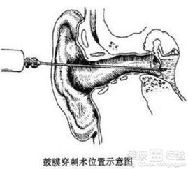 耳郭突出的原因,耳郭突出怎么引起的