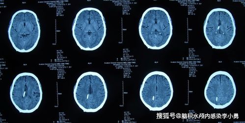 脑积水脑室腹腔分流术后反复发热3个月, 外院4次分流管腹腔端调整术均失败