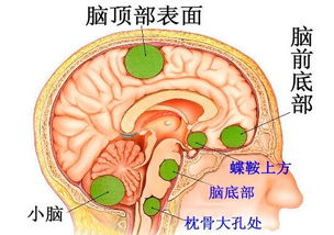 脑癌头疼的症状表现 