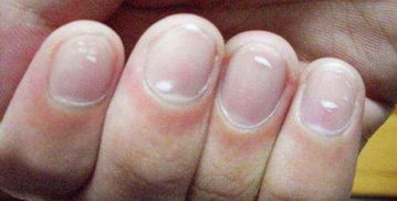指甲有白点，手指甲有白点点是什么原因