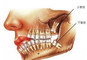 牙科故事丨一颗智牙的故事