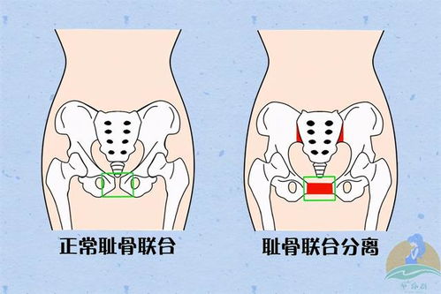 孕期最难熬的一种痛,31 的孕妈都经历过,预防和缓解看七个方法