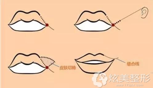 做完嘴角上扬手术后3个月出现增生疤痕怎么处理