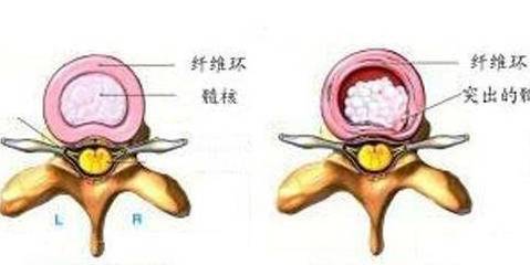 腰脱的症状主要是什么(腰脱怎么治效果最好)