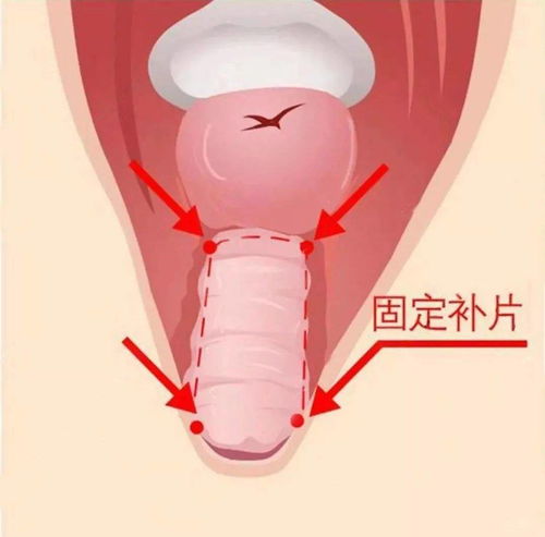 产后阴道松弛怎么办 阴道紧缩手术让女性找回自信