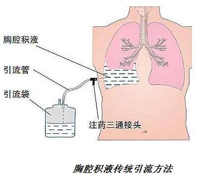 肺癌产生恶性胸水怎么办 胸外科专家沈晓咏科普系列