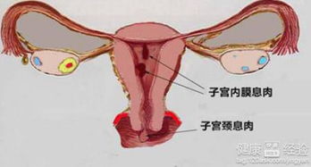 双侧输卵管堵塞 子宫内膜息肉怎么治疗