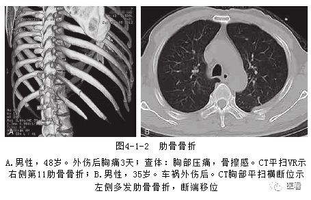 肋骨骨折错位的图片 搜狗图片搜索