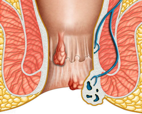 承山穴,专业医生告诉你,它不止治小腿疼痛,也是治疗痔疮的要穴