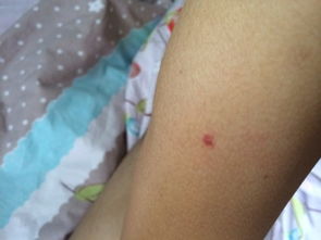 突然右手臂起了两个红点 以前没长过不痛不痒,也不是蚊子咬的 