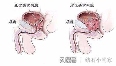 前列腺低温等离子汽化电切术 安全快速治疗前列腺增生
