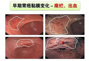 辟谣 胃胀查出胃癌,不到40天就死去,胃癌不能早期发现吗