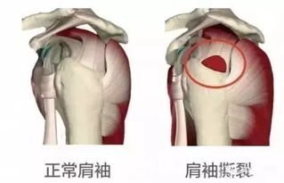 肩周炎 对肩痛的认识误区