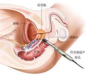 前列腺癌患者选择手术治疗或可以延长生存期 