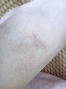 症状持续大概有两三个月了,就是脚踝附近起好多褐色斑点,摸上去不光 