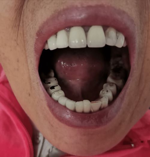 长沙六旬老太天天刷牙还是满口 烂牙 ,戴上假牙后频频感到口干,专家 可能患上这个病