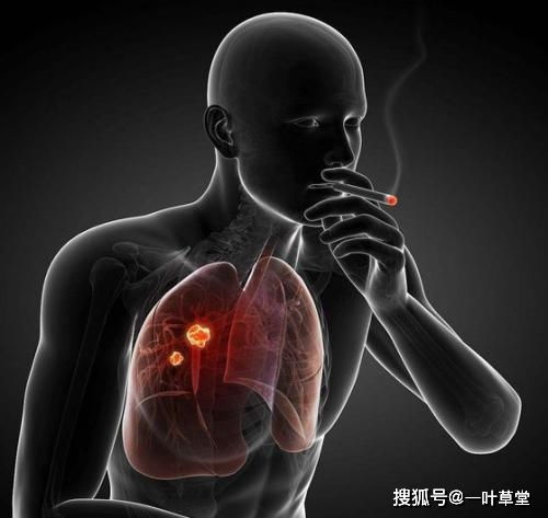 肺部容易病变的八字原来是有这样的标志