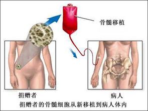 再障,如果进行骨髓移植的成功率如何