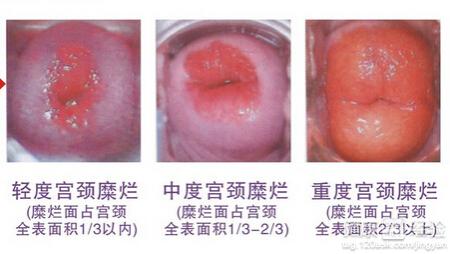 宫禁糜烂中度影响怀孕吗