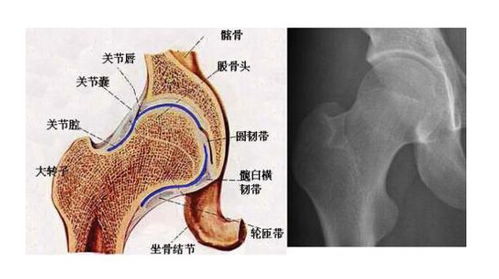 人工股骨头都有哪些种材料，都各有什么特性？