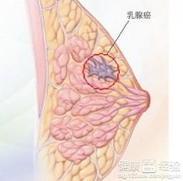 乳腺癌化疗不能吃什么