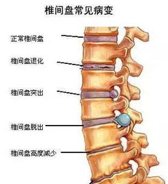 脊椎怎么治疗,颈椎压迫脊椎怎么治疗