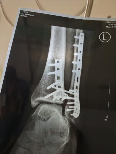脚跟骨粉碎性骨折手术已经三个月了还不能下地走路脚脖子弯曲的幅度太小不能蹲该如何段炼 