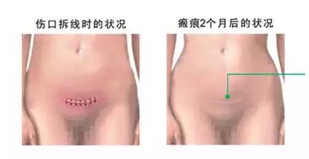 剖腹产后疤痕多久修复,剖腹产之后多久能做疤痕修复?