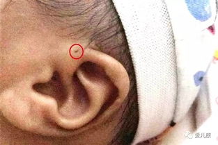 专家在线丨人人都说宝宝的 耳仓 是福气,为何医生说它是先天性疾病