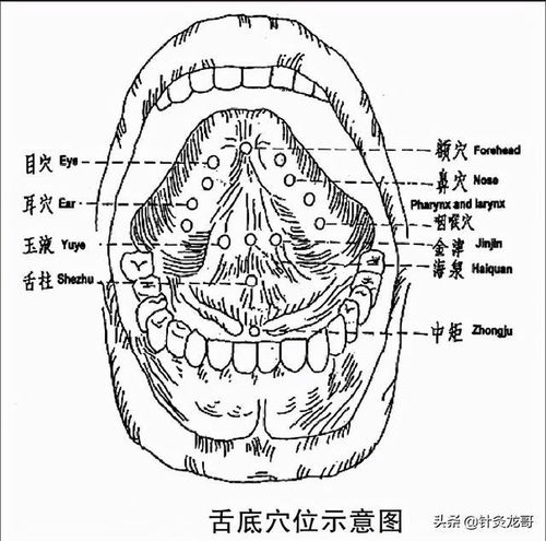 中风后吞咽困难只知道舌三针和点刺舌头 其实另一个部位也很重要