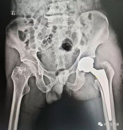 股骨头手术后照片 文章资讯阅读 图客 Tukexw Com