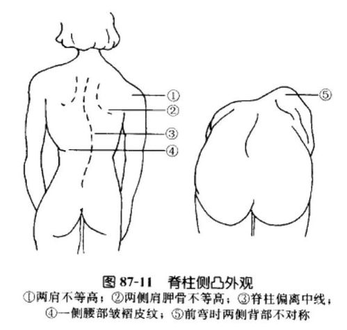 得了脊柱侧弯,你可能还不知道 这些早期症状,进来自测一下